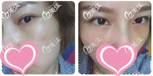 外切去眼袋手术一个月效果 外切去眼袋手术一个月效果