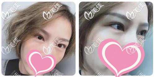 外切去眼袋手术半个月 外切去眼袋手术半个月