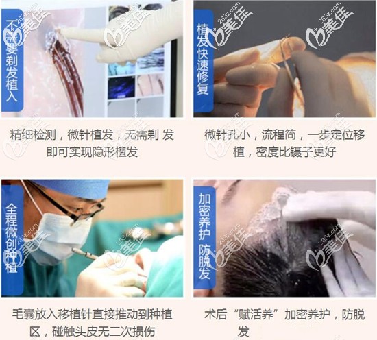 广州华美先进的毛发移植技术 广州华美先进的毛发移植技术