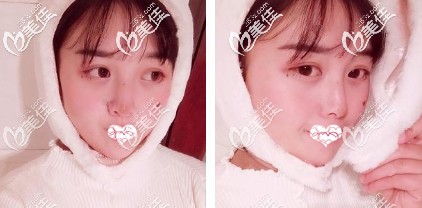 做完鼻综合术后1个月鼻子基本恢复 做完鼻综合术后1个月鼻子基本恢复