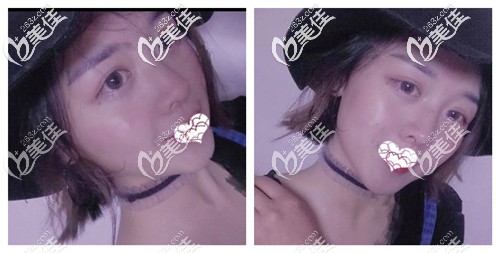 综合鼻整形术后2个月鼻子基本恢复 综合鼻整形术后2个月鼻子基本恢复