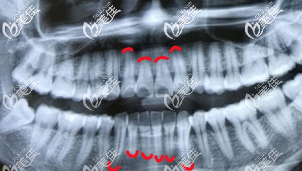 先天性牙根短小全景片示意图