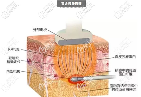 黄金微雕原理