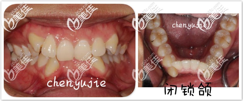 难道隐形牙套解决不了深覆合么？其实隐适美矫正闭锁型深覆合脸型也有改善的