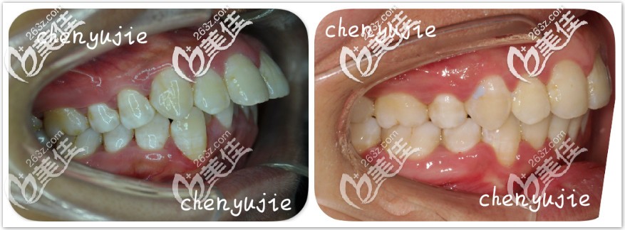 门牙外凸隐形矫正前后对比图 门牙外凸隐形矫正前后对比图