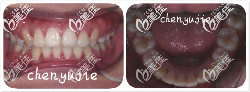 深覆合牙齿前后变化图 深覆合牙齿前后变化图