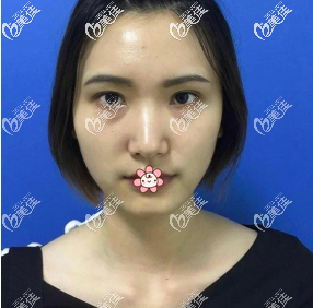 熬夜导致了我的眼袋很重 熬夜导致了我的眼袋很重