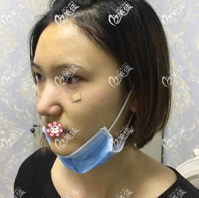 单喆医生给我做完手术三天后 单喆医生给我做完手术三天后