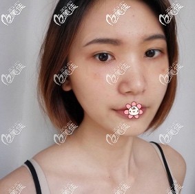 重庆军科内切祛眼袋半个月后 重庆军科内切祛眼袋半个月后