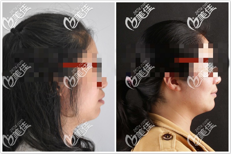 深覆合矫正后脸型也有改善 深覆合矫正后脸型也有改善