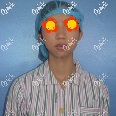 做鼻子下巴前的我 做鼻子下巴前的我