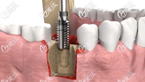 种牙价格为什么那么贵