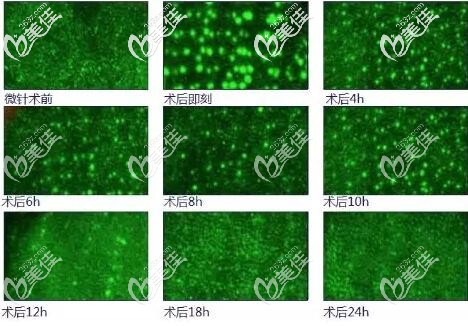 微针治疗后的变化情况