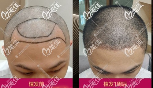 广州华美发际线植发案例 广州华美发际线植发案例