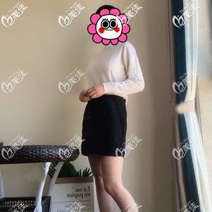 到宁波壹加壹做大腿吸脂恢复一个月