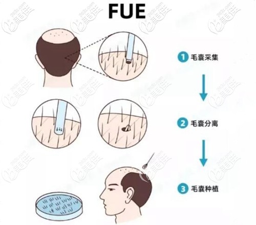 植发手术操作过程原理 植发手术操作过程原理