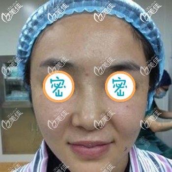 做全脸埋线提升后法令纹得到改善 做全脸埋线提升后法令纹得到改善