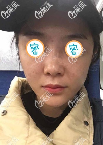 全脸埋线提升半个月的变化 全脸埋线提升半个月的变化