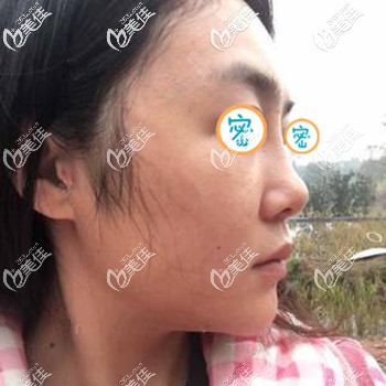 面部埋线提升的伤口不明显 面部埋线提升的伤口不明显