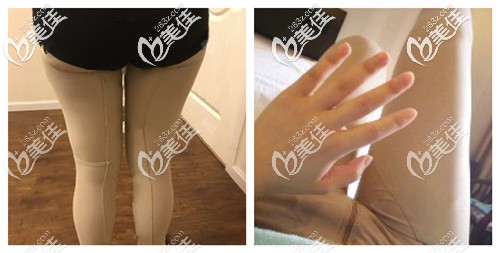 刚做完吸脂术后大腿肿胀 刚做完吸脂术后大腿肿胀