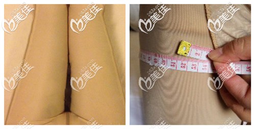 吸脂瘦大腿手术后穿塑腿裤有助于腿部线条塑造 吸脂瘦大腿手术后穿塑腿裤有助于腿部线条塑造