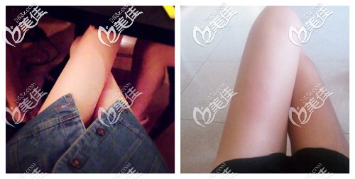 吸脂瘦大腿术后3个月腿围变小 吸脂瘦大腿术后3个月腿围变小