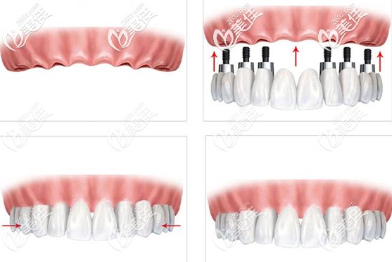 做满口种植牙的价格介绍 做满口种植牙的价格介绍