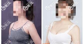 特贝茨隆胸真人案例:特贝茨隆胸3个月效果对比图 特贝茨隆胸真人案例:特贝茨隆胸3个月效果对比图