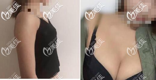 我做特贝茨隆胸3个月恢复效果给大家看 我做特贝茨隆胸3个月恢复效果给大家看