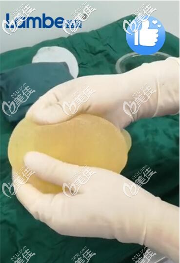 十年前的蓝贝假体