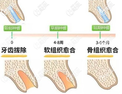 即刻种植、早期种植和延期种植图解