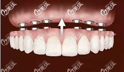 口腔王怀元做种植牙怎么样 口腔王怀元做种植牙怎么样