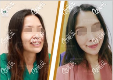 小切口全脸提升图片 小切口全脸提升图片