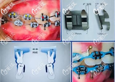 MBT直丝弓正畸技术 MBT直丝弓正畸技术