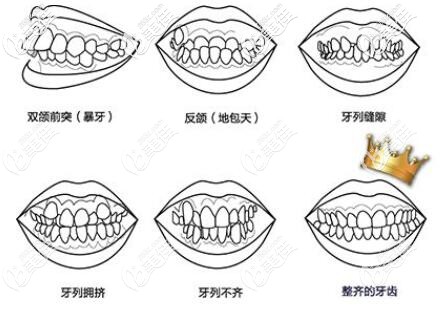 牙齿畸形的表现
