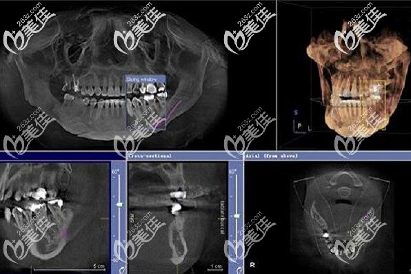 <!--<i data=20240703-sp></i>-->口腔全口种植牙CT片 <!--<i data=20240703-sp></i>-->口腔全口种植牙CT片