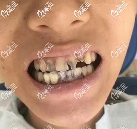 宁波恩吉口腔全瓷牙真人案例 宁波恩吉口腔全瓷牙真人案例