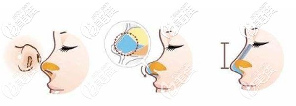 鼻综合手术过程