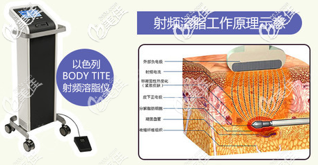 黄金微雕射频溶脂工作原理示意图 黄金微雕射频溶脂工作原理示意图