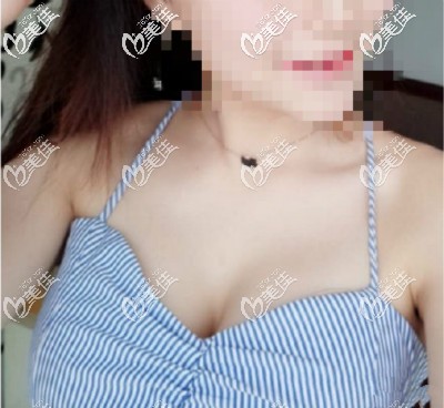 我做曼托水滴225cc假体隆胸直接变成C罩杯