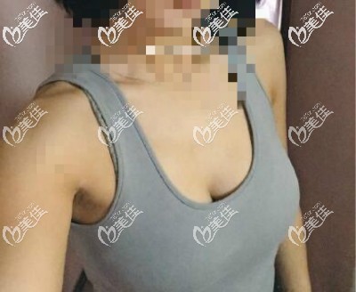 曼托水滴225cc假体隆胸术后25天<span style=