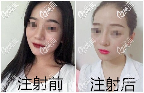 法思丽隆鼻注射效果 法思丽隆鼻注射效果