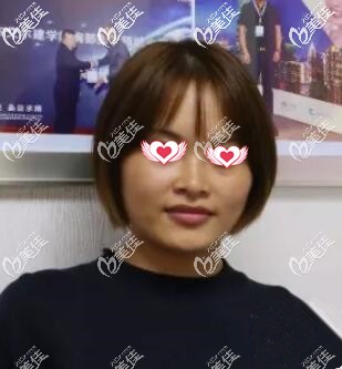 做超体隆鼻术前照 做超体隆鼻术前照