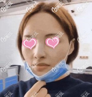 超体隆鼻术后当天照 超体隆鼻术后当天照