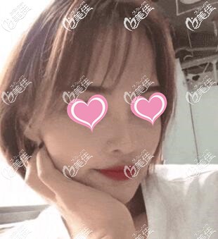 超体隆鼻术后14天照片 超体隆鼻术后14天照片