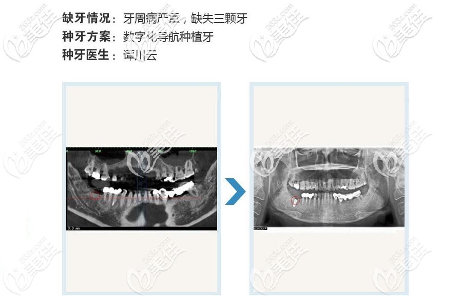 柏乐口腔种植牙案例