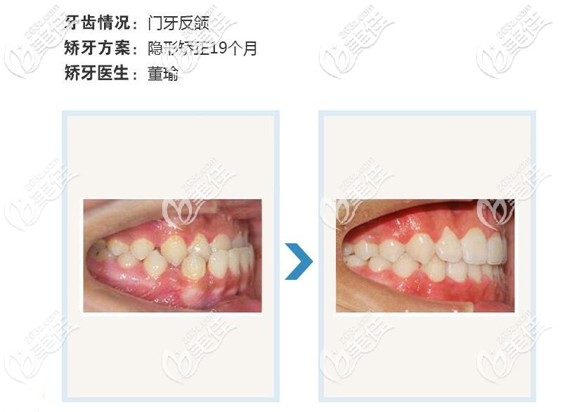 门牙反颌矫正案例