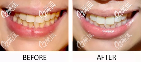 皓齿美白是冷光美白的升级版! 皓齿美白是冷光美白的升级版!