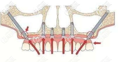 穿颧种植牙图片