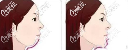 侧脸没有下颌线怎么办 侧脸没有下颌线怎么办